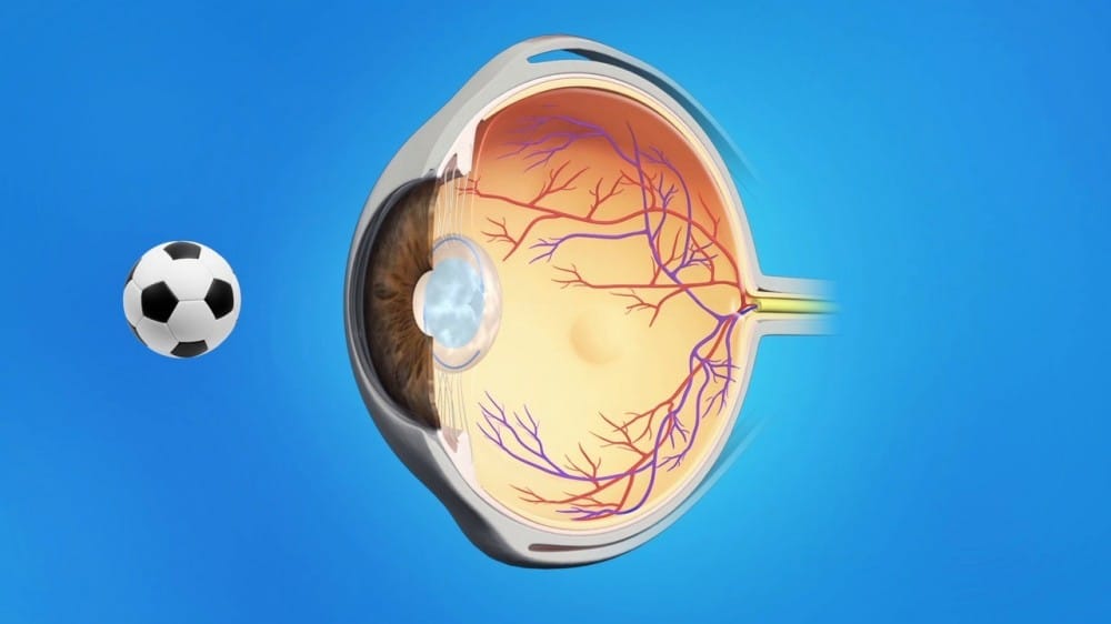 cataract 2 cataract 2